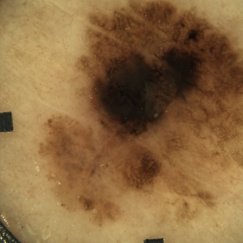 Agresyviausias odos vėžys neskauda, o progresuoti gali ir per mėnesį: onkologai kviečia nemokamai pasitikrinti